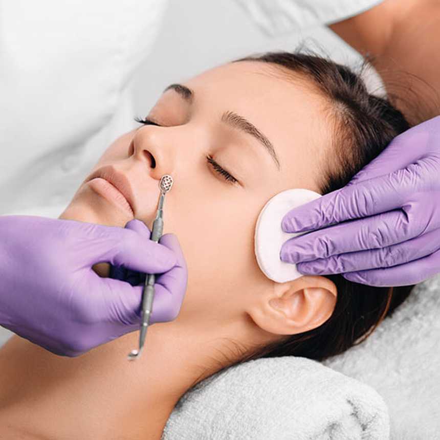  What You Ought to Know About Blackhead Extraction