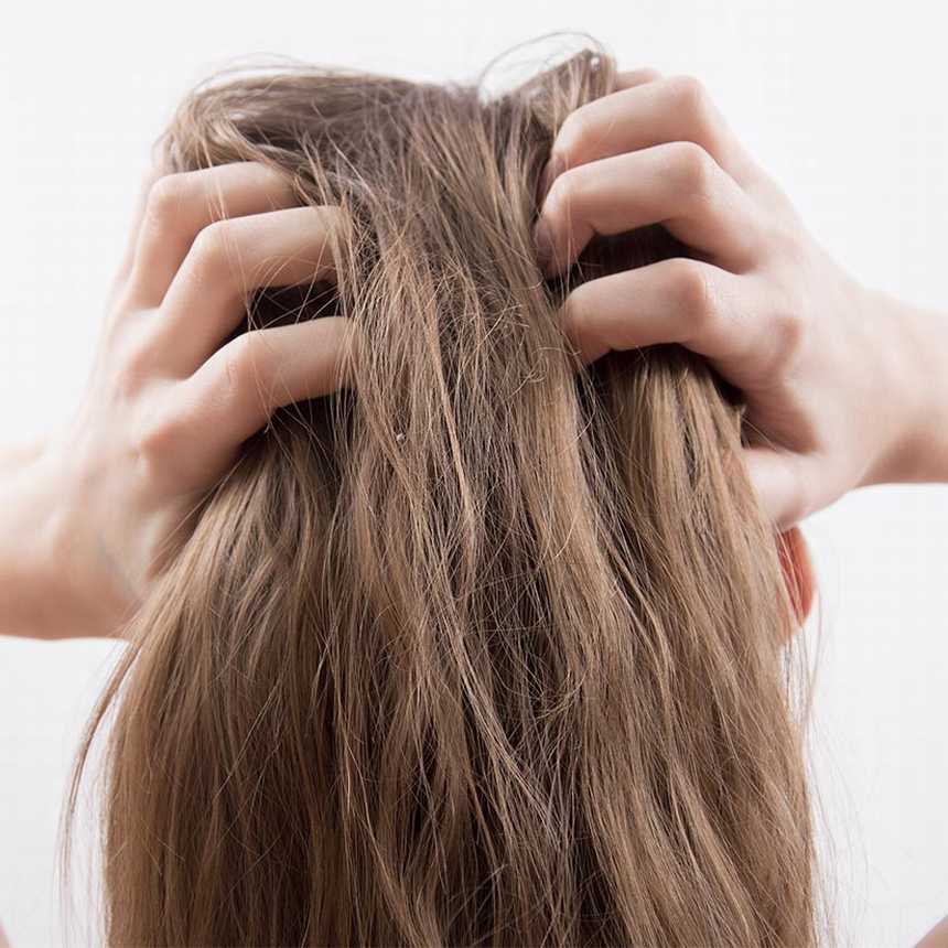  What Is Scalp Psoriasis?