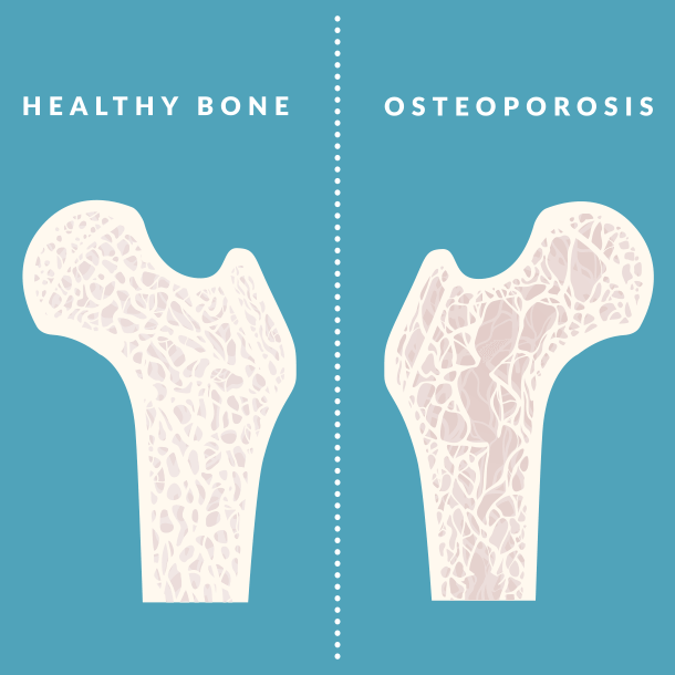  What Is Osteoporosis? Therapy, Signs, Medicine