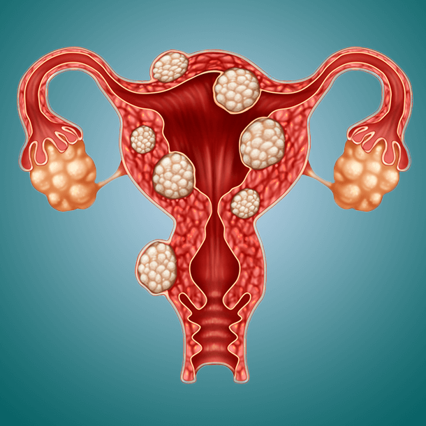  What Are Uterine Fibroids? Signs, Therapy, Footage